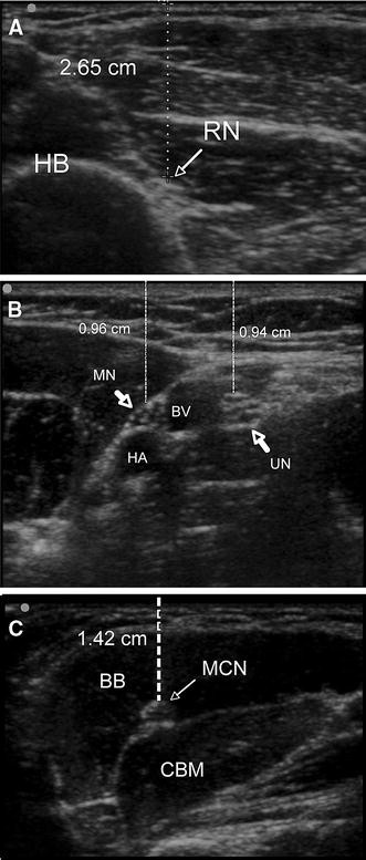 ultrasound guided radial nerve block