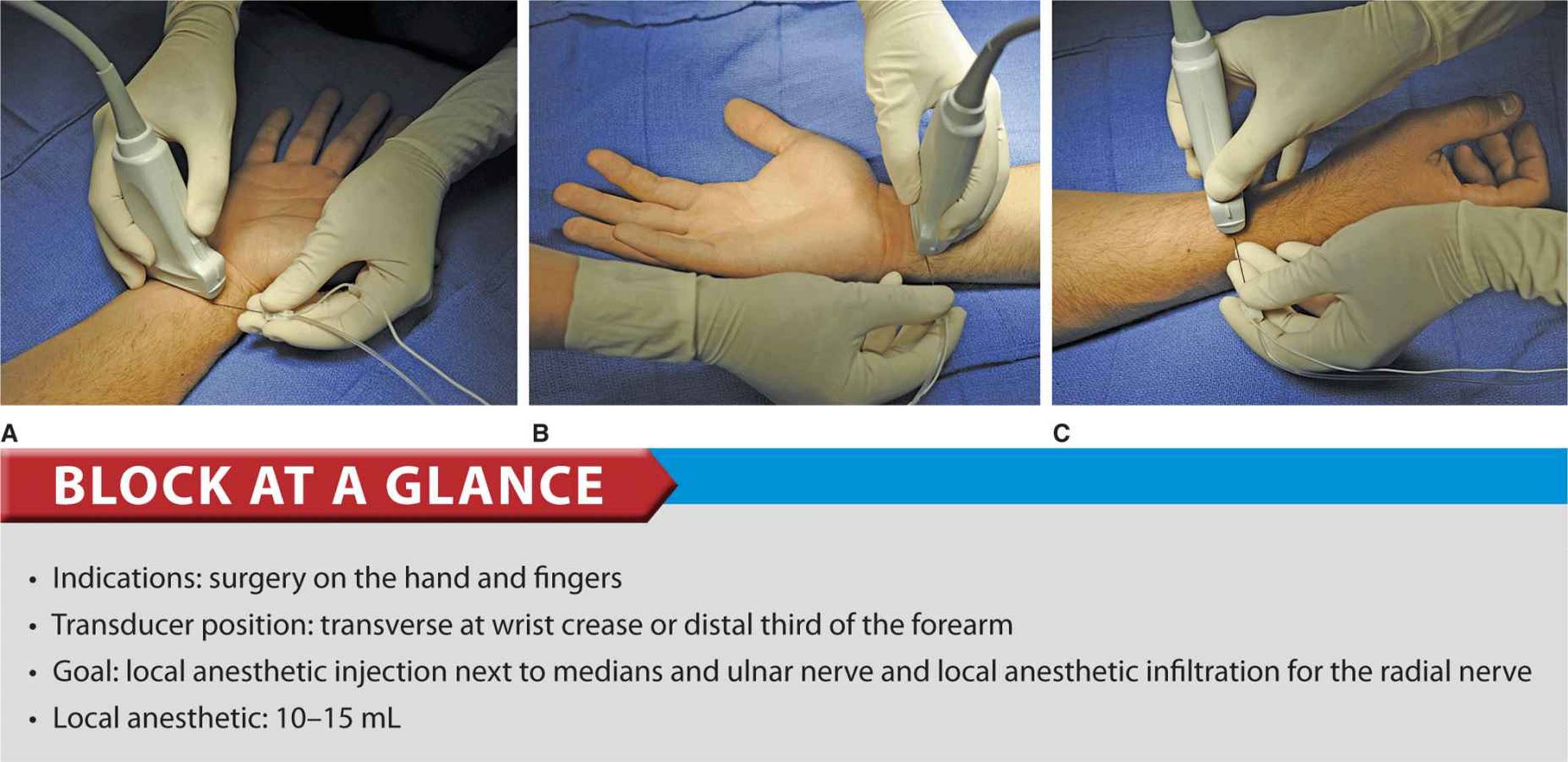 ultrasound guided radial nerve block