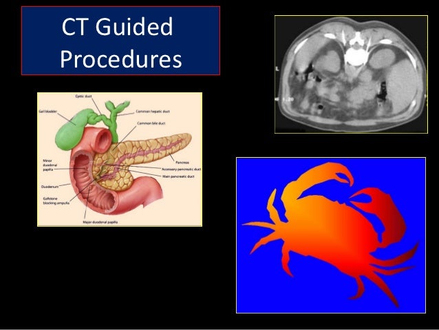 ct guided injection side effects