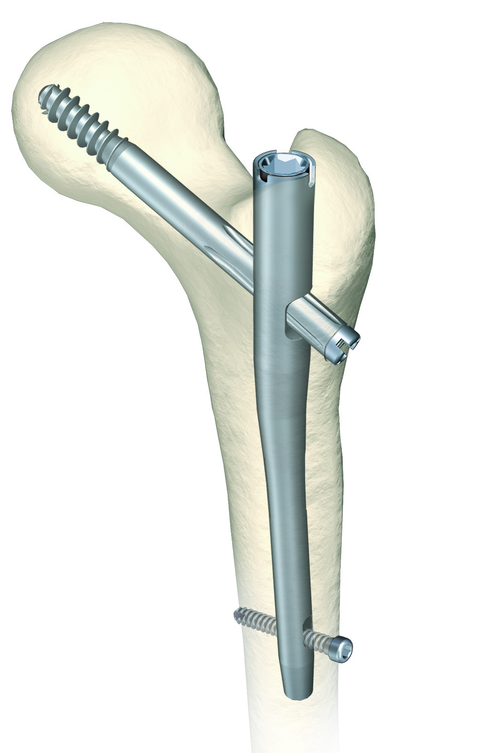 smith and nephew hip replacement technique guide